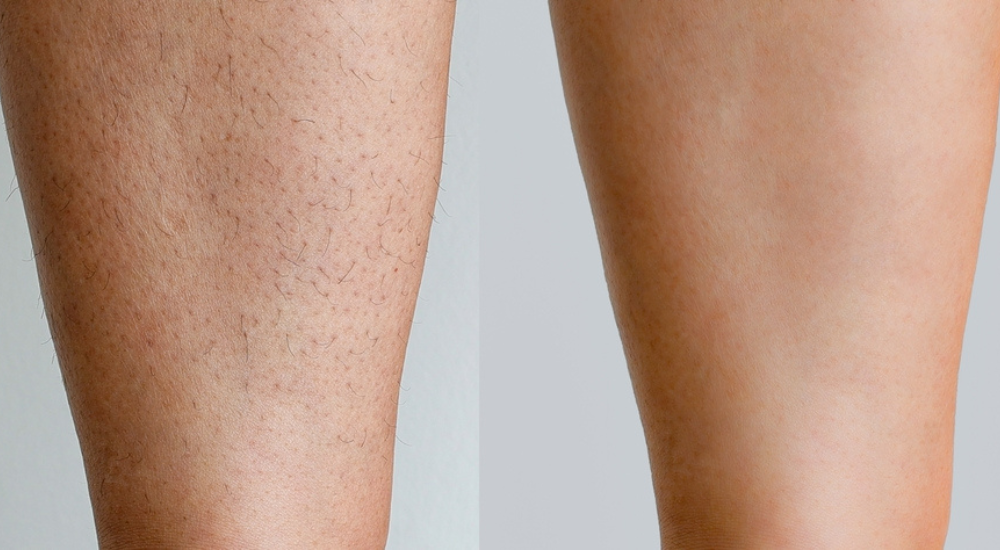 Mezoterápia _ Peeling _ Kozmetika