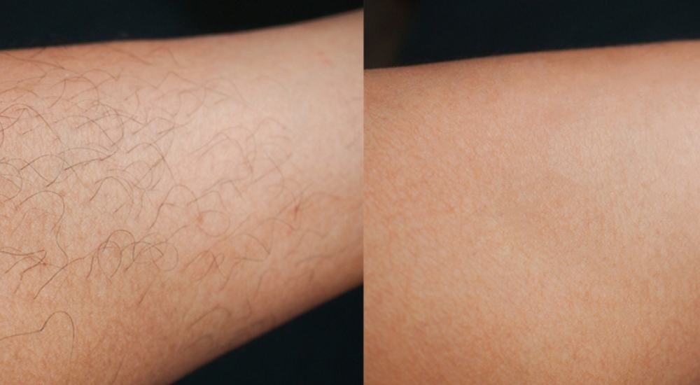 Mezoterápia _ Peeling _ Kozmetika