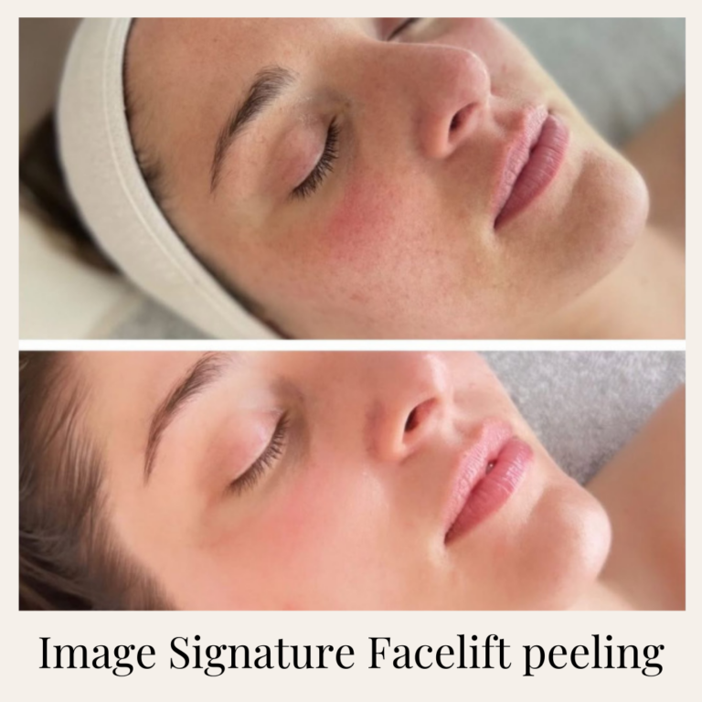 Mezoterápia _ Peeling _ Kozmetika