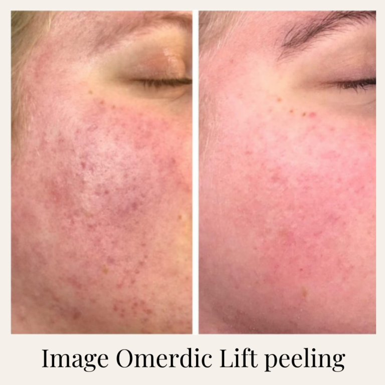 Mezoterápia _ Peeling _ Kozmetika