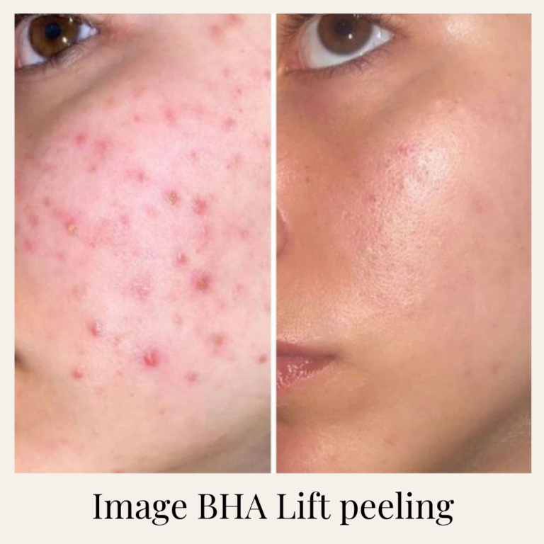 Mezoterápia _ Peeling _ Kozmetika