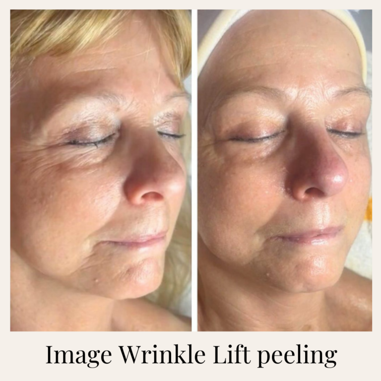 Mezoterápia _ Peeling _ Kozmetika