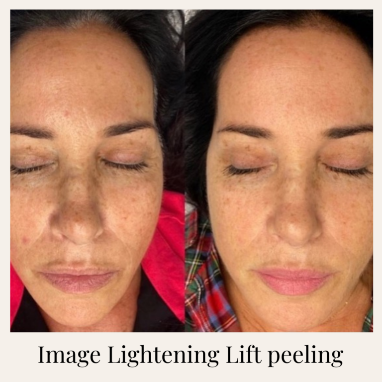 Mezoterápia _ Peeling _ Kozmetika